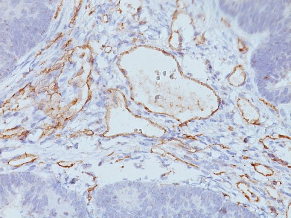 Formalin-fixed, paraffin-embedded Colon Carcinoma stained with CD31 Mouse Monoclonal Antibody (C31.3+C31.7+C31.10).