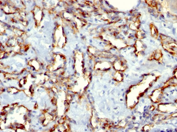 Formalin-fixed, paraffin-embedded Angiosarcoma stained with CD31 Mouse Monoclonal Antibody (C31.3+C31.7+C31.10).