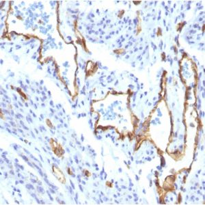 Formalin-fixed, paraffin-embedded human Angiosarcoma stained with CD31-Monospecific Recombinant Rabbit Monoclonal Antibody (C31/1395R).