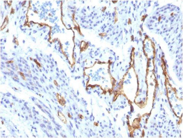 Formalin-fixed, paraffin-embedded human Angiosarcoma stained with CD31-Monospecific Recombinant Rabbit Monoclonal Antibody (C31/1395R).