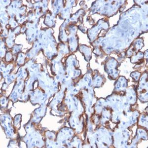 Formalin-fixed, paraffin-embedded human Angiosarcoma stained with CD31 Rabbit Recombinant Monoclonal Antibody (C31/2876R).