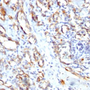 Formalin-fixed, paraffin-embedded human Angiosarcoma stained with CD31 Rabbit Polyclonal Antibody.