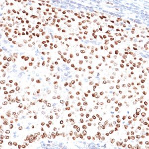 Formalin-fixed, paraffin-embedded human breast carcinoma stained with Progesterone Receptor Mouse Monoclonal Antibody (PR484).
