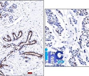 Formalin-fixed, paraffin-embedded normal human breast (left) and invasive ductal carcinoma (right) stained with progesterone receptor Ab (PR501).