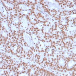 Formalin-fixed, paraffin-embedded human Endometrial Carcinoma stained with Progesterone Receptor Mouse Monoclonal Antibody (PGR/2694).