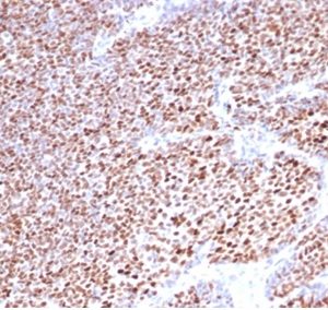 Formalin-fixed, paraffin-embedded human breast carcinoma stained with Progesterone Receptor Mouse Monoclonal Antibody (PGR/3817).