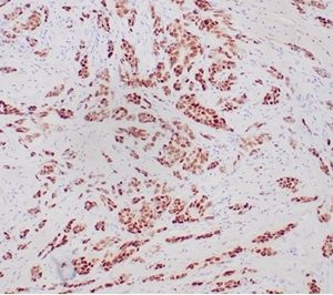 Formalin-fixed, paraffin-embedded human breast carcinoma stained with PR Recombinant Rabbit Monoclonal Antibody (PGR/6854R).