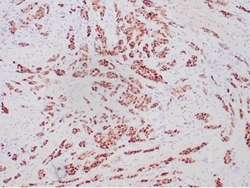 Formalin-fixed, paraffin-embedded human breast carcinoma stained with PR Recombinant Rabbit Monoclonal Antibody (PGR/6854R).