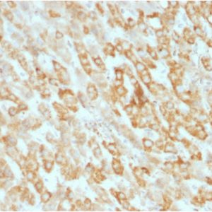 Formalin-fixed, paraffin-embedded human Hepatic Carcinoma stained with Prohibitin Mouse Monoclonal Antibody (SPM311).