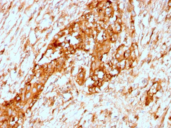 Formalin-fixed, paraffin-embedded human Breast stained with Alpha-1-Antitrypsin Recombinant Rabbit Monoclonal Antibody (AAT/3167R). HIER: Tris/EDTA, pH9.0, 45min. 2°C: HRP-polymer, 30min. DAB, 5min.