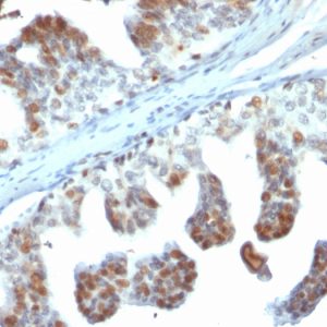 Formalin-fixed, paraffin-embedded human Prostate Carcinoma stained with PTEN Mouse Monoclonal Antibody (PTEN/2110).