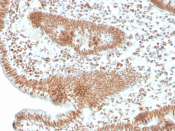 Formalin-fixed, paraffin-embedded human colon carcinoma stained with PMS2 Recombinant Rabbit Monoclonal Antibody (PMS2/4373R).