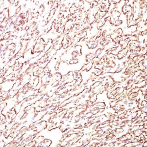 Formalin-fixed, paraffin-embedded human Angiosarcoma stained with Podocalyxin Monoclonal Antibody (4F10).
