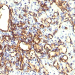 Formalin-fixed, paraffin-embedded human Angiosarcoma stained with Podocalyxin Monoclonal Antibody (2A4).