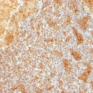 Formalin-fixed, paraffin-embedded human Salivary Tumor stained with Cytochrome C Monoclonal Antibody (SPM389).