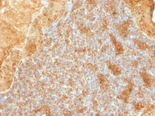 Formalin-fixed, paraffin-embedded human Salivary Tumor stained with Cytochrome C Monoclonal Antibody (SPM389).