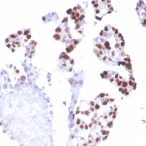 Formalin-fixed, paraffin-embedded human Breast Carcinoma stained with RNA Polymerase II / Poll II Mouse Monoclonal Antibody (CTD4H8).