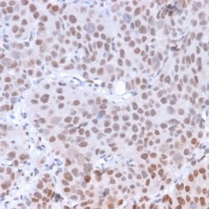 Formalin-fixed, paraffin-embedded human Colon Carcinoma stained with  RNA Polymerase II / Poll II Mouse Monoclonal Antibody (8A7).