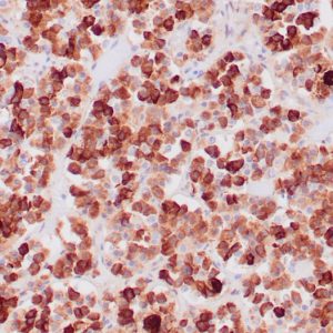 Formalin-fixed, paraffin-embedded human pituitary adenoma stained with ACTH Mouse Monoclonal Antibody (CLIP/1407).