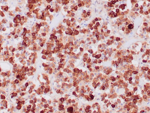 Formalin-fixed, paraffin-embedded human pituitary adenoma stained with ACTH Mouse Monoclonal Antibody (CLIP/1407).