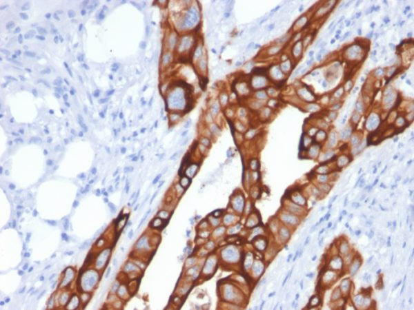 Formalin-fixed, paraffin-embedded human Colon Carcinoma stained with Cytokeratin 20 (KRT20) Mouse Monoclonal Antibody (KRT20/1991).