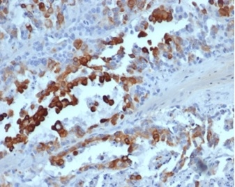 Formalin-fixed, paraffin-embedded human colon adenocarcinoma stained with Cytokeratin 20 Recombinant Mouse Monoclonal Antibody (rKRT20/6536). HIER: Tris/EDTA, pH9.0, 45min. 2°C: HRP-polymer, 30min. DAB, 5min.