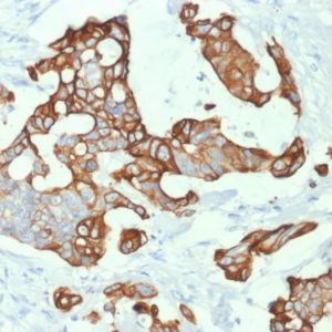 Formalin-fixed, paraffin-embedded human Colon Carcinoma stained with Cytokeratin 20 (KRT20) Mouse Monoclonal Antibody (KRT20/1992).