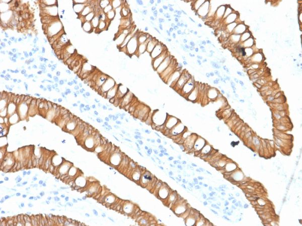 Formalin-fixed, paraffin-embedded human Colon Carcinoma stained with Cytokeratin 20 (KRT20) Mouse Monoclonal Antibody (SPM140).