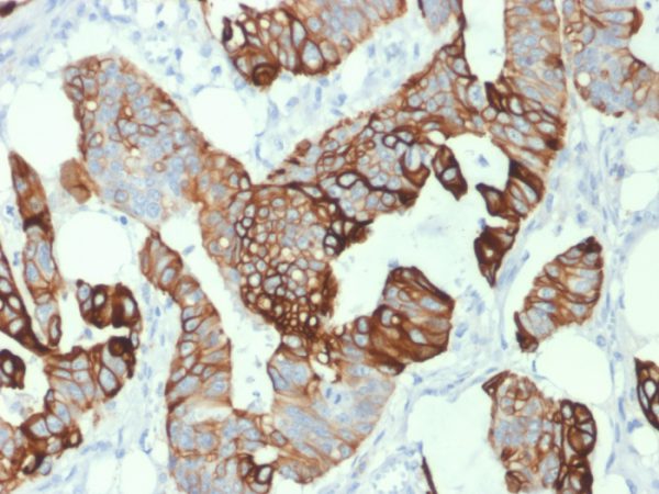 Formalin-fixed, paraffin-embedded human Colon Carcinoma stained with Cytokeratin 20 (KRT20) Mouse Monoclonal Antibody (KRT20/1993).