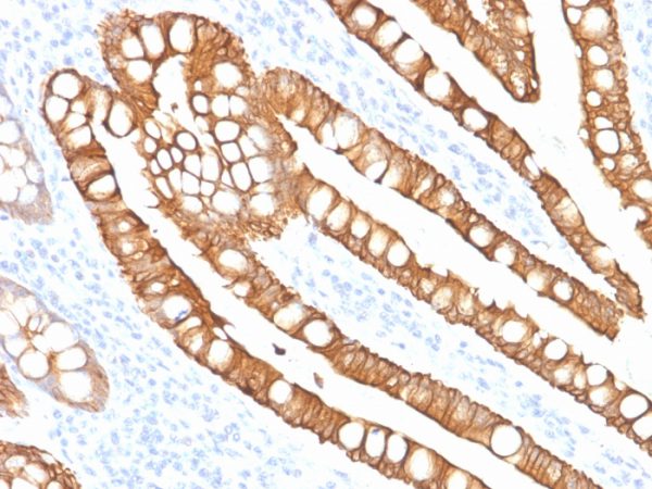 Formalin-fixed, paraffin-embedded human Colon Carcinoma stained with Cytokeratin 20 (KRT20) Mouse Monoclonal Antibody (SPM191).