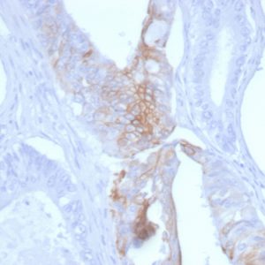 Formalin-fixed, paraffin-embedded human Colon Carcinoma stained with Cytokeratin 20 Mouse Monoclonal Antibody (KRT20/3145).