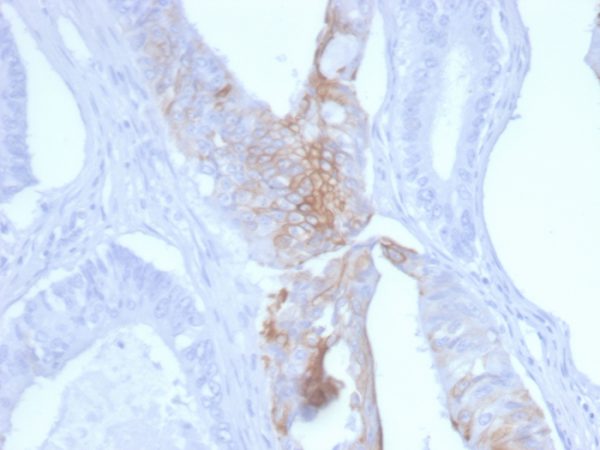 Formalin-fixed, paraffin-embedded human Colon Carcinoma stained with Cytokeratin 20 Mouse Monoclonal Antibody (KRT20/3145).