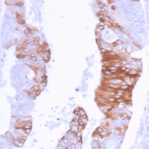 Formalin-fixed, paraffin-embedded human Colon Carcinoma stained with Cytokeratin 20 Recombinant Rabbit Monoclonal Antibody (KRT20/3129R).