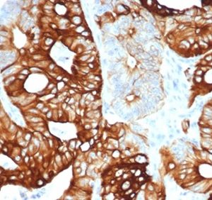 Formalin-fixed, paraffin-embedded human colon carcinoma stained with Cytokeratin 20 Recombinant Rabbit Monoclonal Antibody (KRT20/4380R). HIER: Tris/EDTA, pH9.0, 45min. 2°C: HRP-polymer, 30min. DAB, 5min.