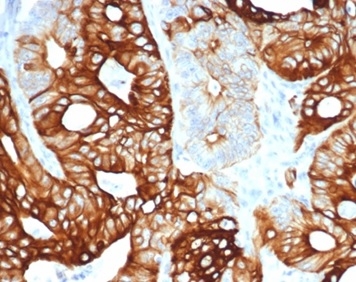 Formalin-fixed, paraffin-embedded human colon carcinoma stained with Cytokeratin 20 Recombinant Rabbit Monoclonal Antibody (KRT20/4380R). HIER: Tris/EDTA, pH9.0, 45min. 2 °: HRP-polymer, 30min. DAB, 5min.