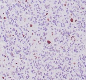 Formalin-fixed, paraffin-embedded human glioma stained with ATRX Recombinant Mouse Monoclonal Antibody (rATRX/3446).