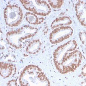 Formalin-fixed, paraffin-embedded human Prostate Carcinoma stained with ATRX Rabbit Recombinant Monoclonal Antibody (ATRX/2900R).