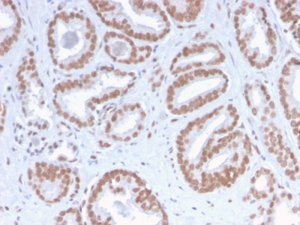 Formalin-fixed, paraffin-embedded human Prostate Carcinoma stained with ATRX Rabbit Recombinant Monoclonal Antibody (ATRX/2900R).