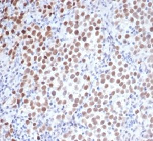 Formalin-fixed, paraffin-embedded human seminoma stained with OCT-4 Mouse Monoclonal Antibody (OCT4/3508) at 2ug/ml. HIER: Tris/EDTA, pH9.0, 45min. 2°C: HRP-polymer, 30min. DAB, 5min.