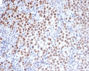 Formalin-fixed, paraffin-embedded human seminoma stained with OCT-4 Mouse Monoclonal Antibody (OCT4/3508) at 2ug/ml. HIER: Tris/EDTA, pH9.0, 45min. 2°C: HRP-polymer, 30min. DAB, 5min.
