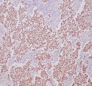 Formalin-fixed, paraffin-embedded human seminoma stained with OCT4 Recombinant Rabbit Monoclonal Antibody (OCT4/6875R) at 2ug/ml. HIER: Tris/EDTA, pH9.0, 45min. 2°C: HRP-polymer, 30min. DAB, 5min.