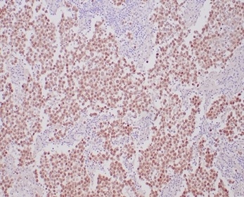 Formalin-fixed, paraffin-embedded human seminoma stained with OCT4 Recombinant Rabbit Monoclonal Antibody (OCT4/6875R) at 2ug/ml. HIER: Tris/EDTA, pH9.0, 45min. 2 °: HRP-polymer, 30min. DAB, 5min.