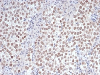 Formalin-fixed, paraffin-embedded human seminoma stained with OCT4 Recombinant Rabbit Monoclonal Antibody (OCT4/6875R) at 2ug/ml. HIER: Tris/EDTA, pH9.0, 45min. 2 °: HRP-polymer, 30min. DAB, 5min.