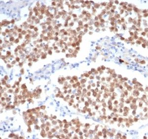 Formalin-fixed, paraffin-embedded human seminoma stained with OCT4 Recombinant Rabbit Monoclonal Antibody (OCT4/6847R) at 2ug/ml. HIER: Tris/EDTA, pH9.0, 45min. 2°C: HRP-polymer, 30min. DAB, 5min.