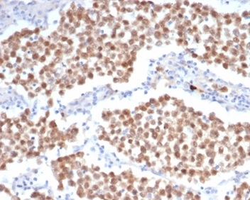 Formalin-fixed, paraffin-embedded human seminoma stained with OCT4 Recombinant Rabbit Monoclonal Antibody (OCT4/6847R) at 2ug/ml. HIER: Tris/EDTA, pH9.0, 45min. 2 °: HRP-polymer, 30min. DAB, 5min.