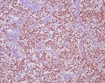 Formalin-fixed, paraffin-embedded human seminoma stained with OCT4 Recombinant Rabbit Monoclonal Antibody (OCT4/6847R). HIER: Tris/EDTA, pH9.0, 45min. 2 °: HRP-polymer, 30min. DAB, 5min.