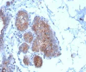 Formalin-fixed, paraffin-embedded human breast carcinoma stained with Migfilin-1 Mouse Monoclonal Antibody (FBLIM1/4600) at 2ug/ml. HIER: Tris/EDTA, pH9.0, 45min. 2°C: HRP-polymer, 30min. DAB, 5min.