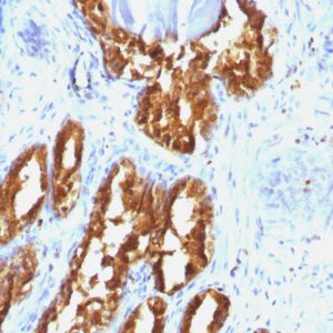 Formalin-fixed, paraffin-embedded human Prostate Carcinoma stained with PSAP Mouse Monoclonal Antibody (ACPP/1338).