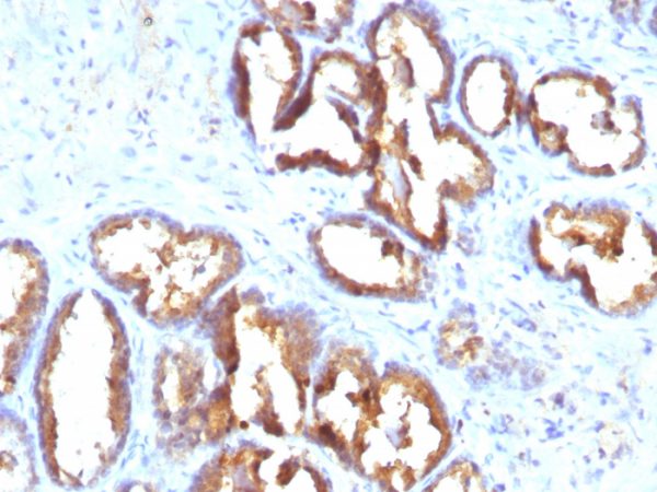 Formalin-fixed, paraffin-embedded human Prostate Carcinoma stained with PSAP Monoclonal Antibody (PASE/4LJ).