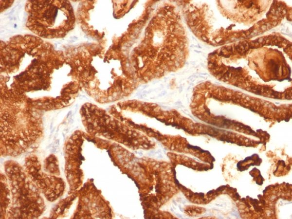 Formalin-fixed, paraffin-embedded human Prostate Carcinoma stained with PSAP Monoclonal Antibody (SPM312).